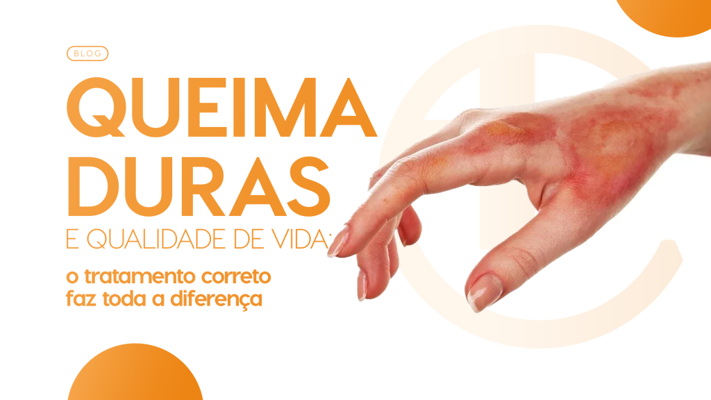 queimaduras e a qualidade de vidas